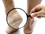 Natural Ways To Remove Cracked Heels