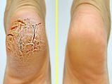 Excellent Kitchen Remedies For Cracked Heels In Tamil