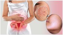 Warning Signs Of Pcos That Appear On Your Skin