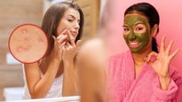 Effective Ways To Remove Whiteheads In Tamil
