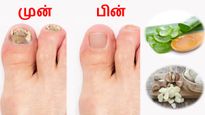 உங்க கால்விரல் நகங்கள் 'இப்படி' அசிங்கமா இருக்கா? இதோ அதை போக்கும் சில இயற்கை வழிகள்!
