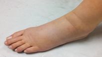 உங்க காலில் இப்படி வீக்கம் இருக்கா? அப்ப நீங்க உடனே டாக்டரை பார்க்கணுமாம்...!