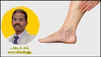 உங்க கால்களில் ரொம்ப நாளா இப்படி இருக்குதா? அசால்ட்டா இருக்காதீங்க.. எச்சரிக்கும் டாக்டர்...!