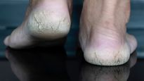 Top 5 Diy Natural Remedies For Cracked Heels