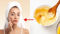 Skin Care Tips Top 5 Acne Fighting Face Masks To Reduce Acne Breakouts