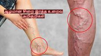 உங்க கால்களில் இப்படி இருக்கா? அப்ப அசால்ட்டா இருக்காதீங்க.. எச்சரிக்கும் நரம்பியல் நிபுணர்!