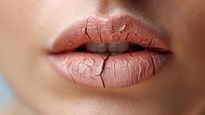 Dry Lips Remedy Top 5 Diy Lip Masks For Chapped Lips During Winter
