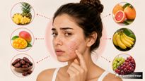 Skin Care Tips 5 Fruits That Can Trigger Acne