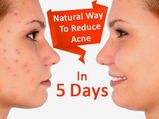 5 రోజుల్లో మొటిమలు నివారించే సింపుల్ ఫేస్ ప్యాక్..