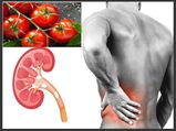 టమోటాలు తింటే మూత్రపిండాలలో రాళ్లకు కారణమవుతుందా? నిజం తెలుసుకోండి ...!