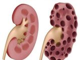 World Kidney Day 2023: మధుమేహం ఉన్నవారికి ఈ ఒక్క లక్షణం కనిపిస్తే కిడ్నీ అవుట్...