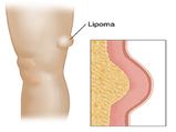 What is Lipoma: చర్మం కింద గడ్డలు మీకూ ఉన్నాయా? అవెంటో తెలుసా?