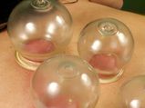 Cupping Therapy: ఎంత కష్టపడ్డా బరువు తగ్గలేకపోతున్నారా.. ఈ థెరపీతో ఈజీగా తగ్గేస్తారు