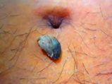 Navel Stone: బొడ్డు చుట్టూ నొప్పి వస్తోందా? రాళ్లు ఏర్పడ్డాయేమో!