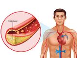 High Cholesterol: మీ శరీరంలో ఈ 3 చోట్ల నొప్పి వస్తే... ప్రమాదకరమైన కొలెస్ట్రాల్ ఎక్కువ అని అర్థం.. జాగ్రత్త!