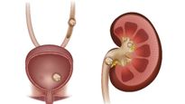 World Kidney Day 2023: కిడ్నీలో రాళ్లు పోవాలంటే రోజూ ఎన్ని నీళ్లు తాగాలి?