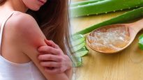Home Remedies for Sweat Rash: చెమట దద్దుర్లు(చెమటకాయలు) లేదా వేడి దద్దుర్లు నివారించడానికి ఇంటి నివారణలు