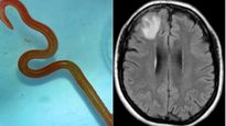 ప్రపంచంలోనే మొదటి కేసు:రోగి మెదడులో మెదులుతున్ననులిపురుగు, 6నెలల నుండి నరకం. స్కానింగ్ తో షాక్ తిన్న వైద్యులు
