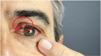 ఇవి కంటి క్యాన్సర్ కు ప్రారంభ లక్షణాలు, ఈ లక్షణాలు శరీరానికి వ్యాపించక ముందే తగిన జాగ్రత్తలు తీసుకోండి