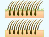  താരനെന്ന വില്ലനെ അകറ്റാനുള്ള മാര്‍ഗ്ഗങ്ങള്‍