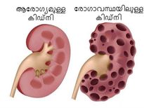 കിഡ്‌നി വേണമെങ്കില്‍ ഈ ശീലങ്ങള്‍ നിര്‍ത്തൂ...