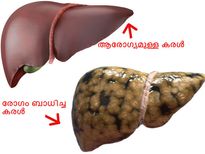 കരളിങ്ങനെയാകേണ്ടെങ്കില്‍ ഈ കാര്യങ്ങള്‍ ശ്രദ്ധിക്കൂ