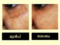 മുഖത്തെ ഫ്രക്കിള്‍സ് പരിഹാരം ഉടന്‍
