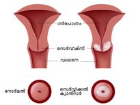 ഈ ലക്ഷണങ്ങള്‍ ഗര്‍ഭാശയ ക്യാന്‍സറിന്റേതാവാം