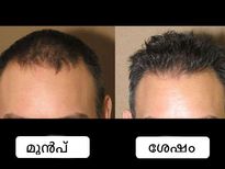 ഈ മുടി കൊഴിച്ചില്‍  പ്രശ്‌നമാകുമ്പോള്‍ പരിഹാരം