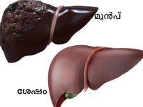 ഒരു മാസം കൊണ്ട് കേടായ കരള്‍ ശരിയാവും