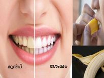 പല്ലിന്റെ മഞ്ഞപ്പും കറയും കളയും പഴത്തൊലി വിദ്യ