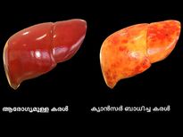 മരണവാതില്‍ തുറക്കും കരള്‍ ക്യാന്‍സര്‍, ലക്ഷണമറിയാം