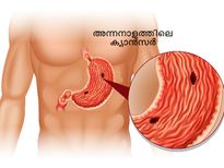  നെഞ്ചെരിച്ചിലെന്ന് ഉറപ്പിക്കണ്ട, ക്യാന്‍സറാവാം