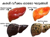 കരളിന്റെ സ്ഥിതി മോശമാണോ,  അറിയാം നേരത്തേ തന്നെ