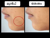 മുഖത്തെ മുറിപ്പാടിന്‌ നിമിഷപരിഹാരം