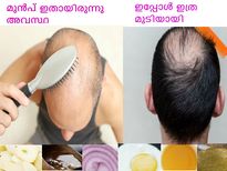 പുരട്ടൂ 20 മിനിറ്റ്, കഷണ്ടിയില്‍ മുടി വളരും