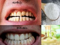 കേടായ പല്ല് പഴയപടിയാക്കും വെളിച്ചെണ്ണവിദ്യ