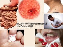 ക്യാന്‍സര്‍ ശരീരത്തിലുണ്ടെന്ന് പറയാതെ പറയും ലക്ഷണം