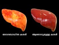കരൾ സംരക്ഷിക്കാനുള്ള വീട്ടുവൈദ്യം