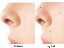 മുഖത്തെ മറുകുകള്‍ ക്ഷണനേരത്തില്‍ മാറ്റാം