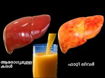 ഫാറ്റി ലിവറിന് മൂന്ന് ദിവസത്തെ ചികിത്സ മതി