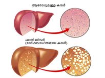 കരളിന്റെ പൂര്‍ണനാശം ഇങ്ങനെ