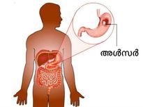 അള്‍സര്‍ മാറ്റും കാബേജ് വിദ്യ സൂപ്പര്‍