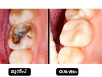 ഏത് ടൂത്ത് പേസ്റ്റിനേക്കാളും നല്ലത് വെളിച്ചെണ്ണ