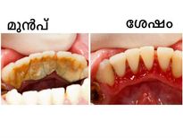 പല്ലിലടിഞ്ഞ അഴുക്കും മഞ്ഞപ്പും തനിയെ നീക്കാം