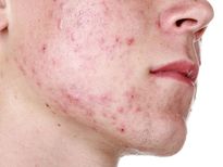 മുഖക്കുരുവിന് കണ്ണടച്ച് തുറക്കും മുന്‍പ് പരിഹാരം