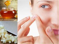 വെളുത്തുള്ളി തേന്‍, മുഖക്കുരു പമ്പ കടക്കും