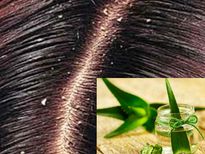 കറ്റാര്‍വാഴ ഇങ്ങനെ, താരന്‍ തരി പോലും ഉണ്ടാകില്ല