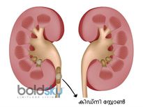 മൂത്രത്തില്‍ കല്ലിനെ തുടക്കത്തില്‍ തിരിച്ചറിയാം