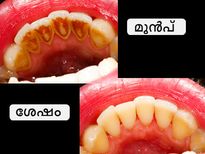 പല്ലിലെ കറ ഇനിയൊരു പ്രശ്‌നമല്ല, 3 ദിവസം മതി